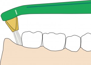 Splayed and swept along the gum line in the case of difficult to access back teeth.